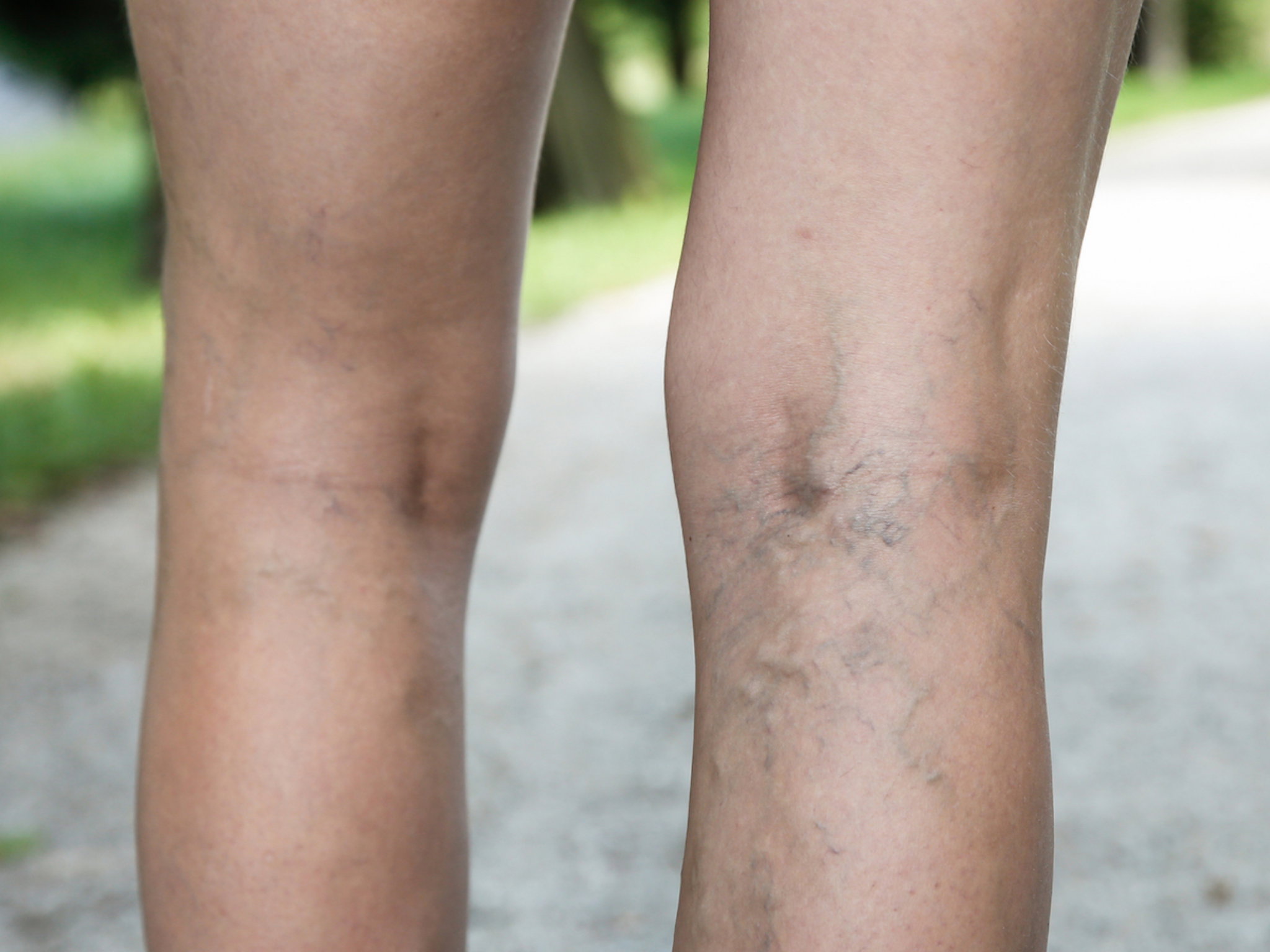 Tratamiento de Insuficiencia Venosa Crónica (Láser o Radiofrecuencia)