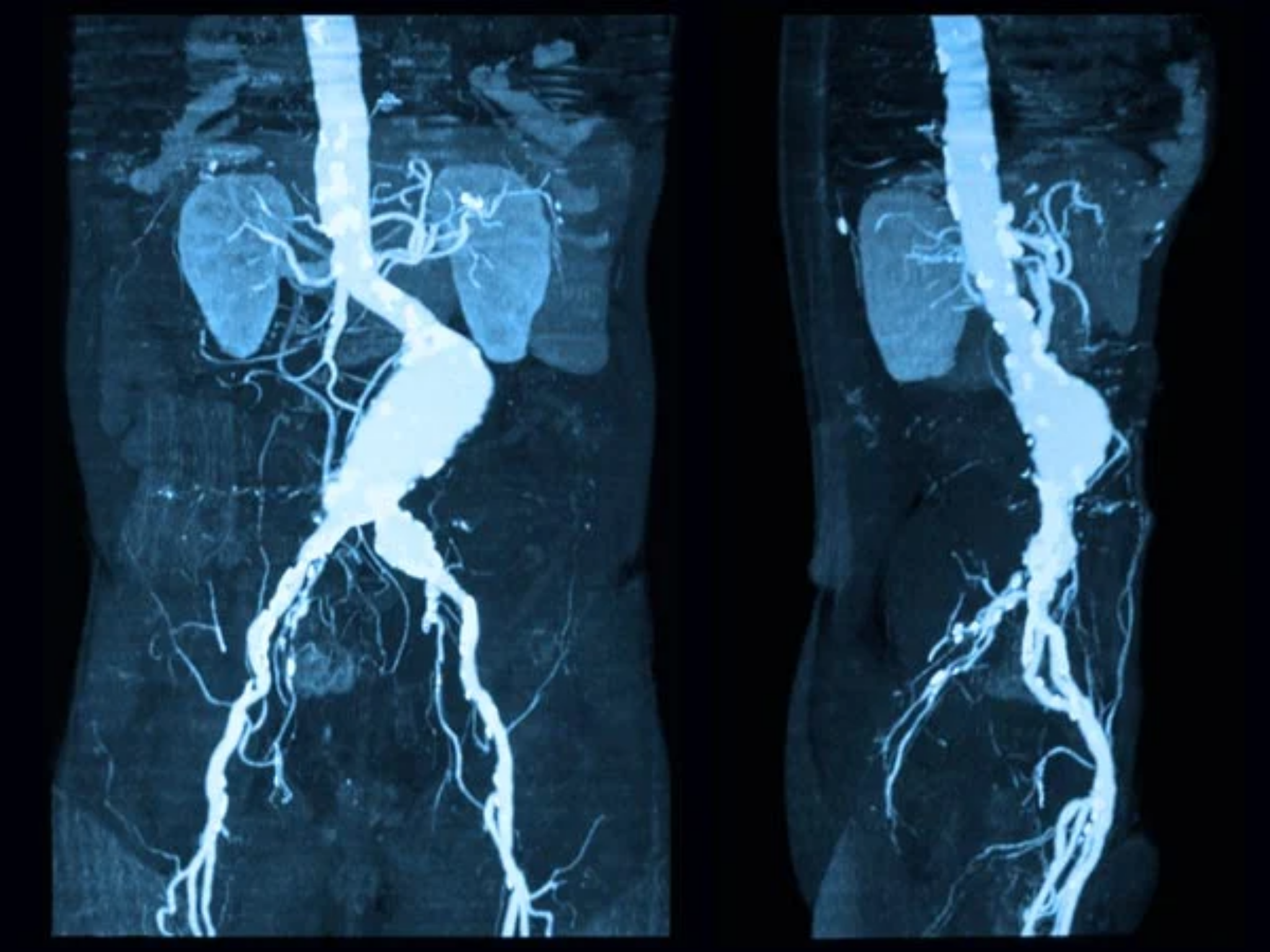 Aneurismas de Aorta Torácica y Abdominal