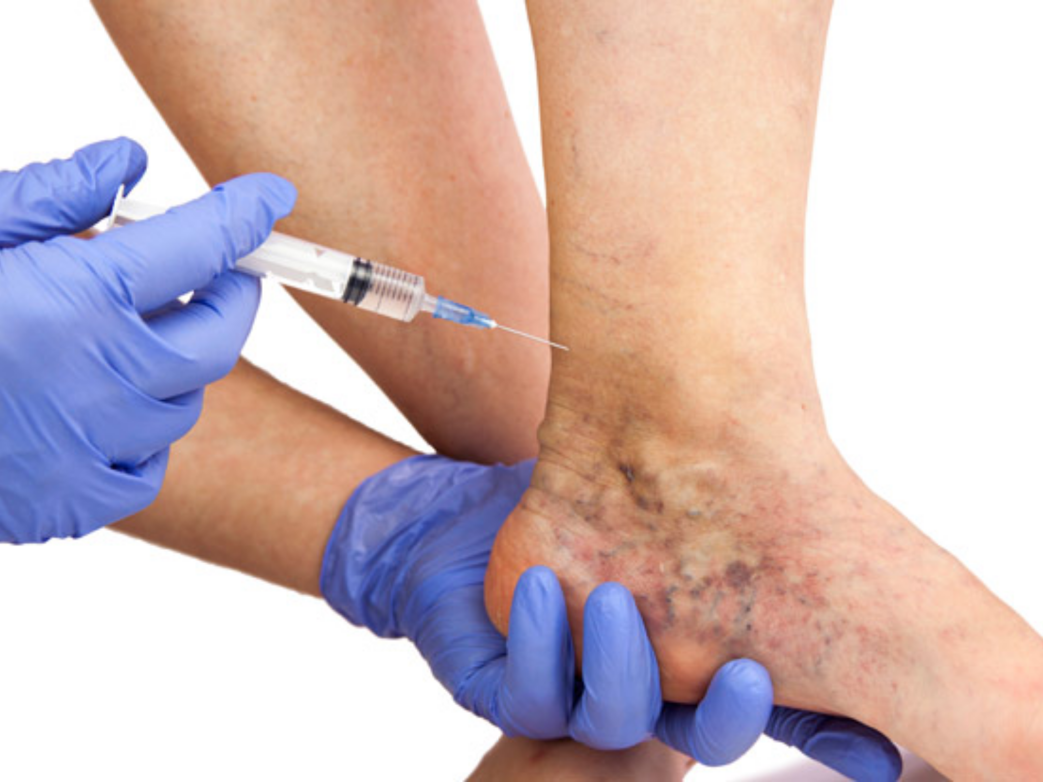 Escleroterapia para Insuficiencia Venosa Crónica en fases iniciale