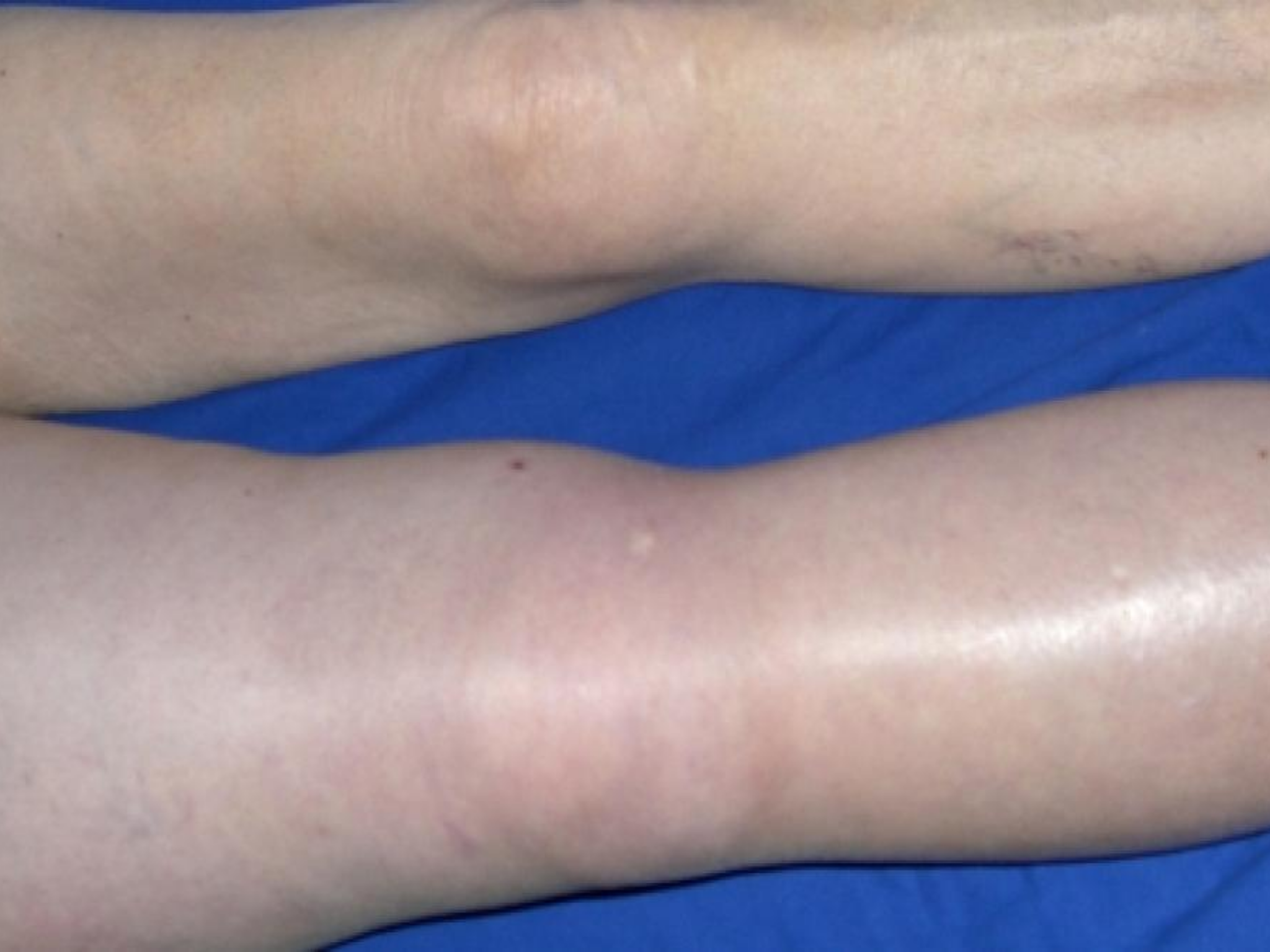 Diagnóstico y Tratamiento de Trombosis Venosa Profunda