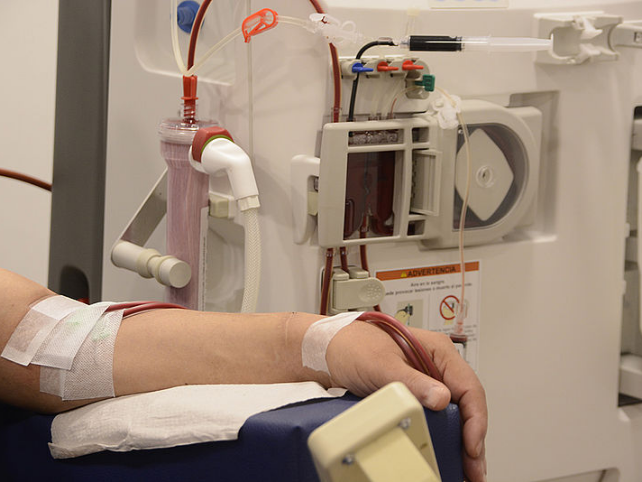 Accesos Vasculares para Enfermedad Renal Crónica en Hemodiálisis (Catéteres y Fístulas Arteriovenosas)