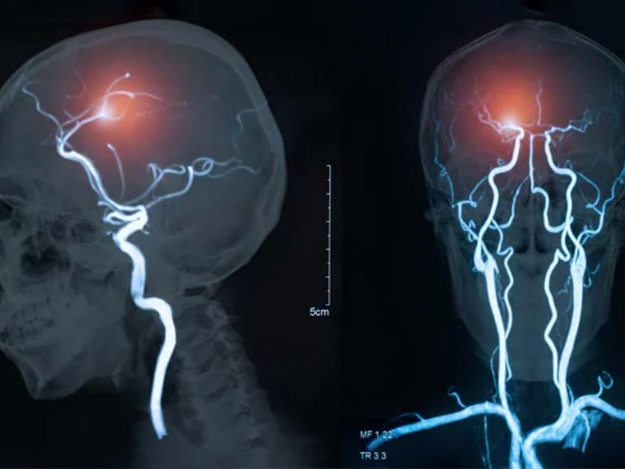 Enfermedad Carotidea / Embolia o Infarto cerebral